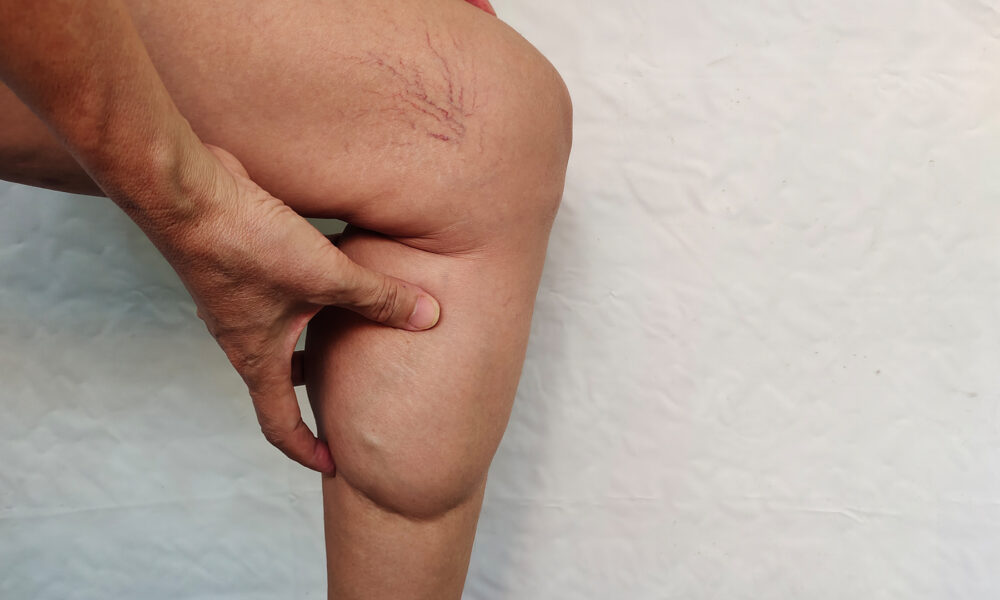 Illustration: Lipödem – Ursachen, Symptome, Typisierung und moderne Behandlungsmöglichkeiten (Plastische Chirurgie Linz)